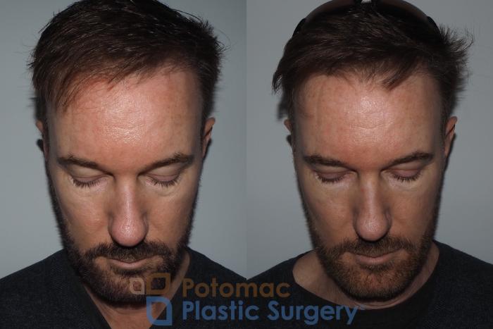 Before & After Liquid Facelift Case 215 Top View in Washington DC & Arlington , DC