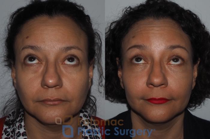 Before & After Brow Lift Case 218 Front View #2 View in Washington, DC