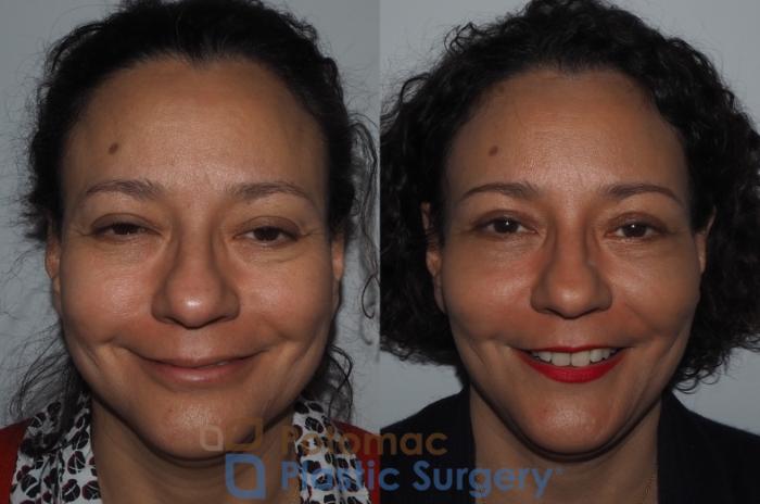Before & After Brow Lift Case 218 Front View #3 View in Washington, DC