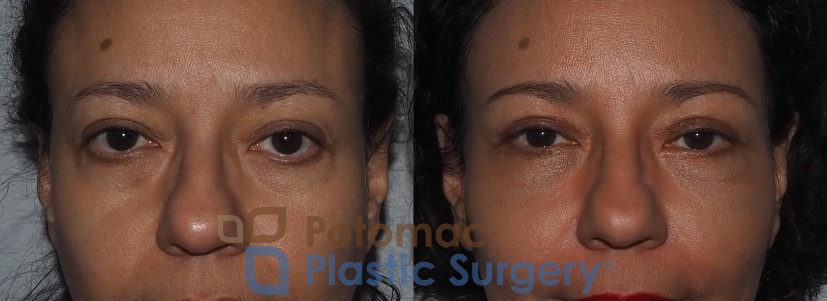 Before & After Blepharoplasty Case 218 Front View Close-Up #1 View in Washington, DC
