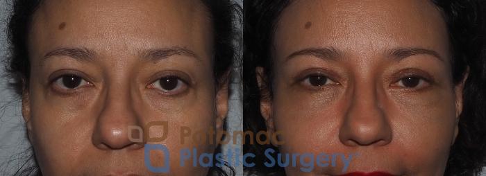 Before & After Blepharoplasty Case 218 Front View Close-Up #1 View in Washington, DC