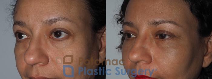 Before & After Brow Lift Case 218 Left Oblique Close-Up View in Washington, DC