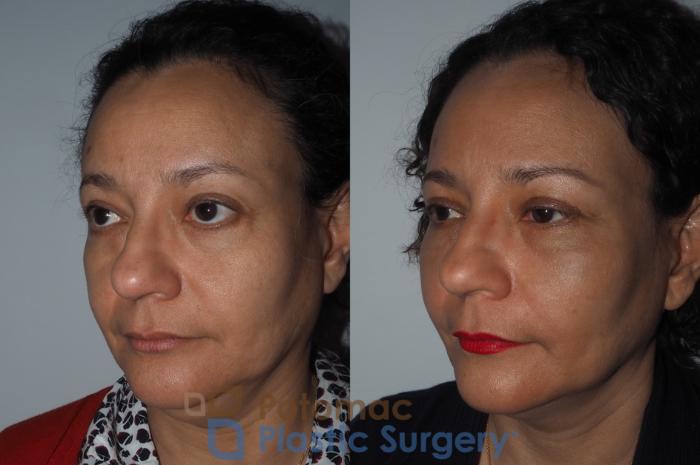 Before & After Brow Lift Case 218 Left Oblique View in Washington, DC