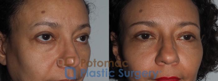 Before & After Blepharoplasty Case 218 Right Oblique Close-Up View in Washington, DC