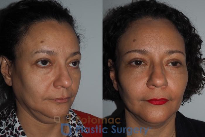 Before & After Blepharoplasty Case 218 Right Oblique View in Washington, DC