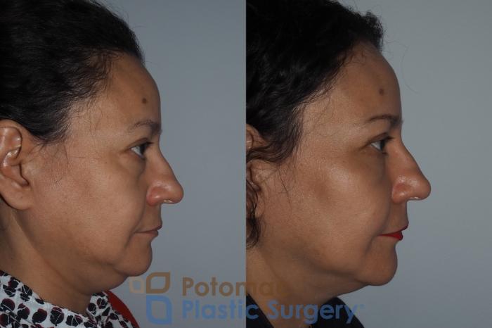 Before & After Brow Lift Case 218 Right Side View in Washington, DC
