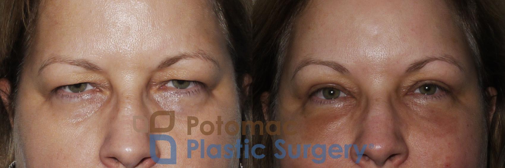 Before & After Blepharoplasty Case 232 Front Close-Up View #1 View in Washington, DC