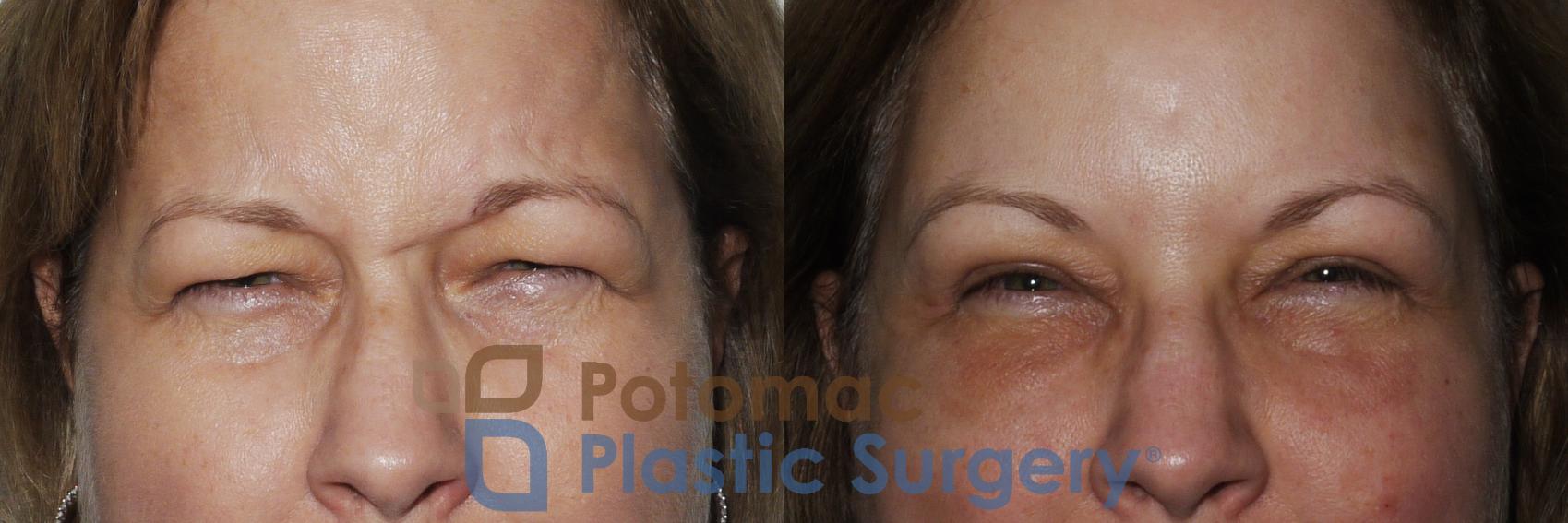 Before & After Blepharoplasty Case 232 Front Close-Up View #2 View in Washington, DC