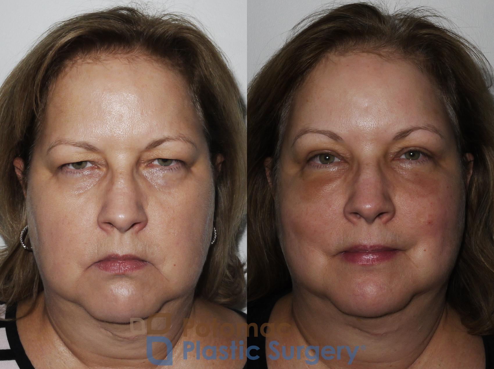 Before & After Blepharoplasty Case 232 Front View #1 View in Washington, DC