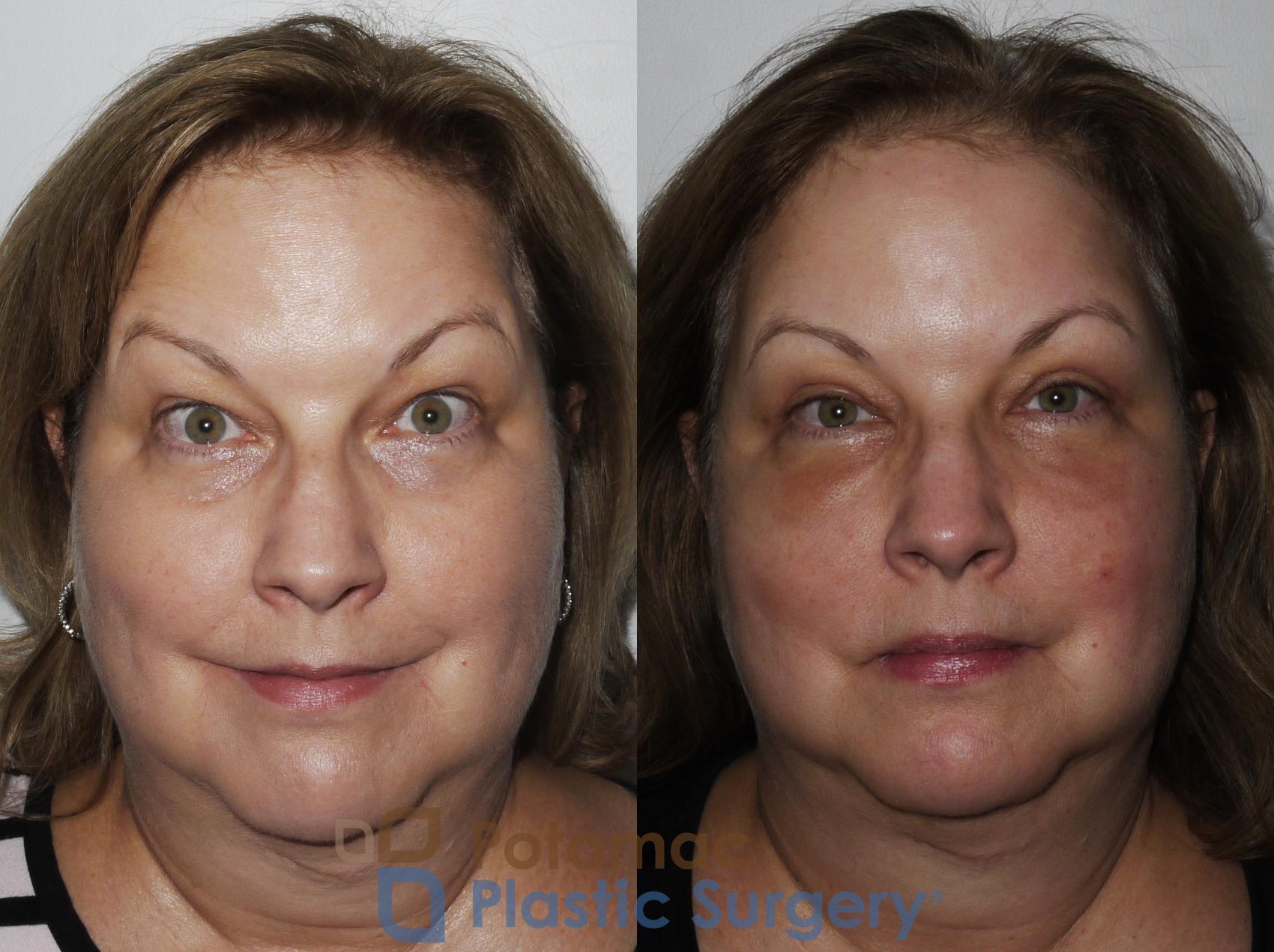 Before & After Blepharoplasty Case 232 Front View #2 View in Washington, DC