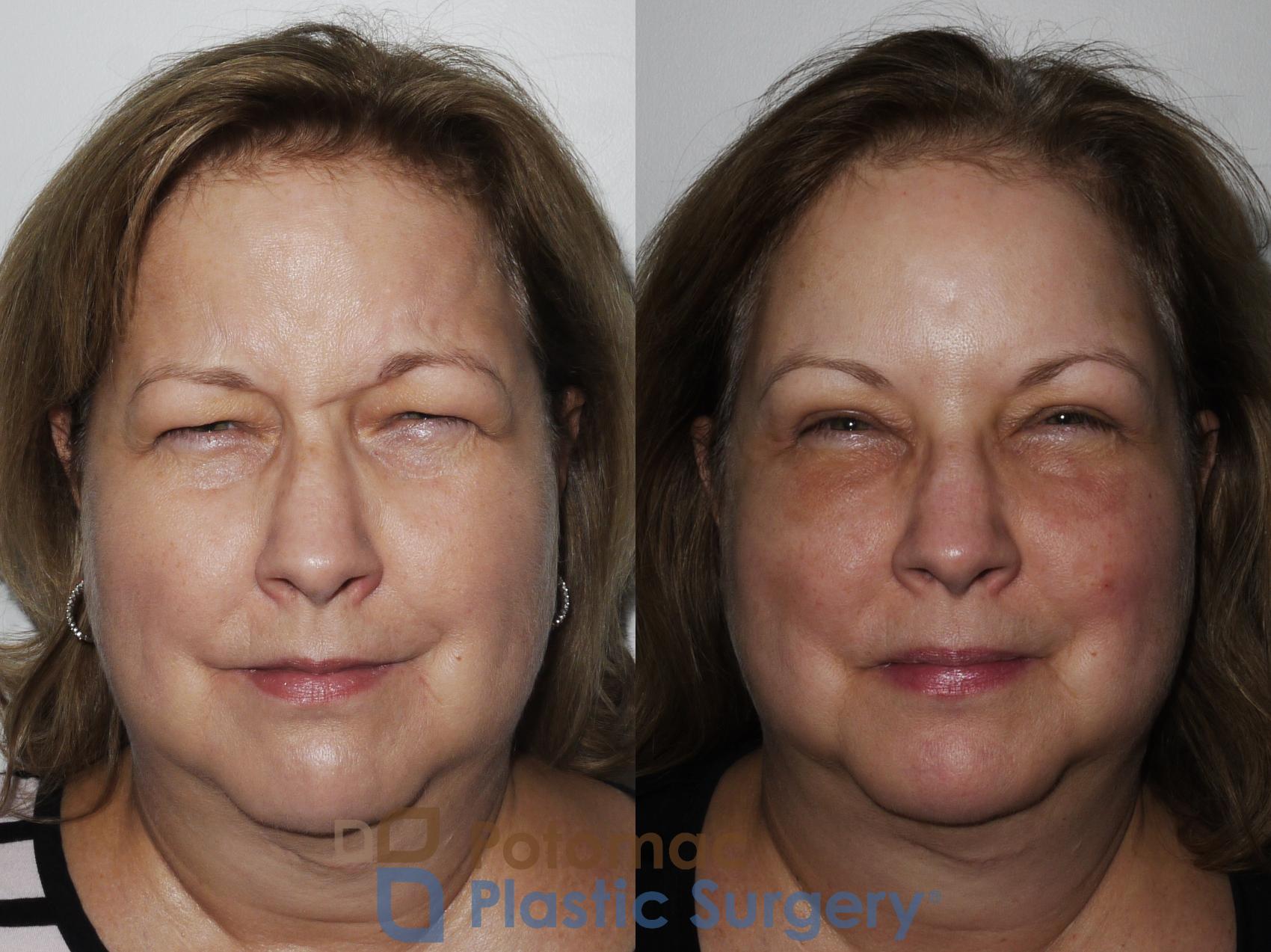 Before & After Blepharoplasty Case 232 Front View #3 View in Washington, DC