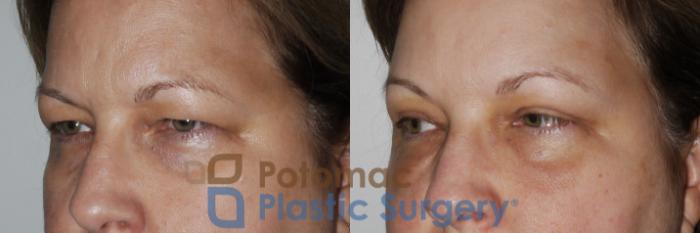 Before & After Brow Lift Case 232 Left Oblique Close-Up View in Washington, DC