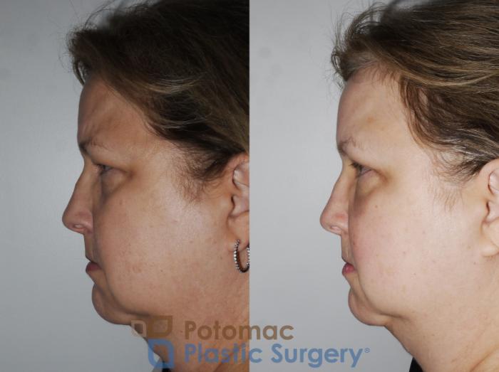 Before & After Brow Lift Case 232 Left Side View in Washington, DC