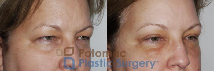 Before & After Brow Lift Case 232 Right Oblique Close-Up View in Washington, DC