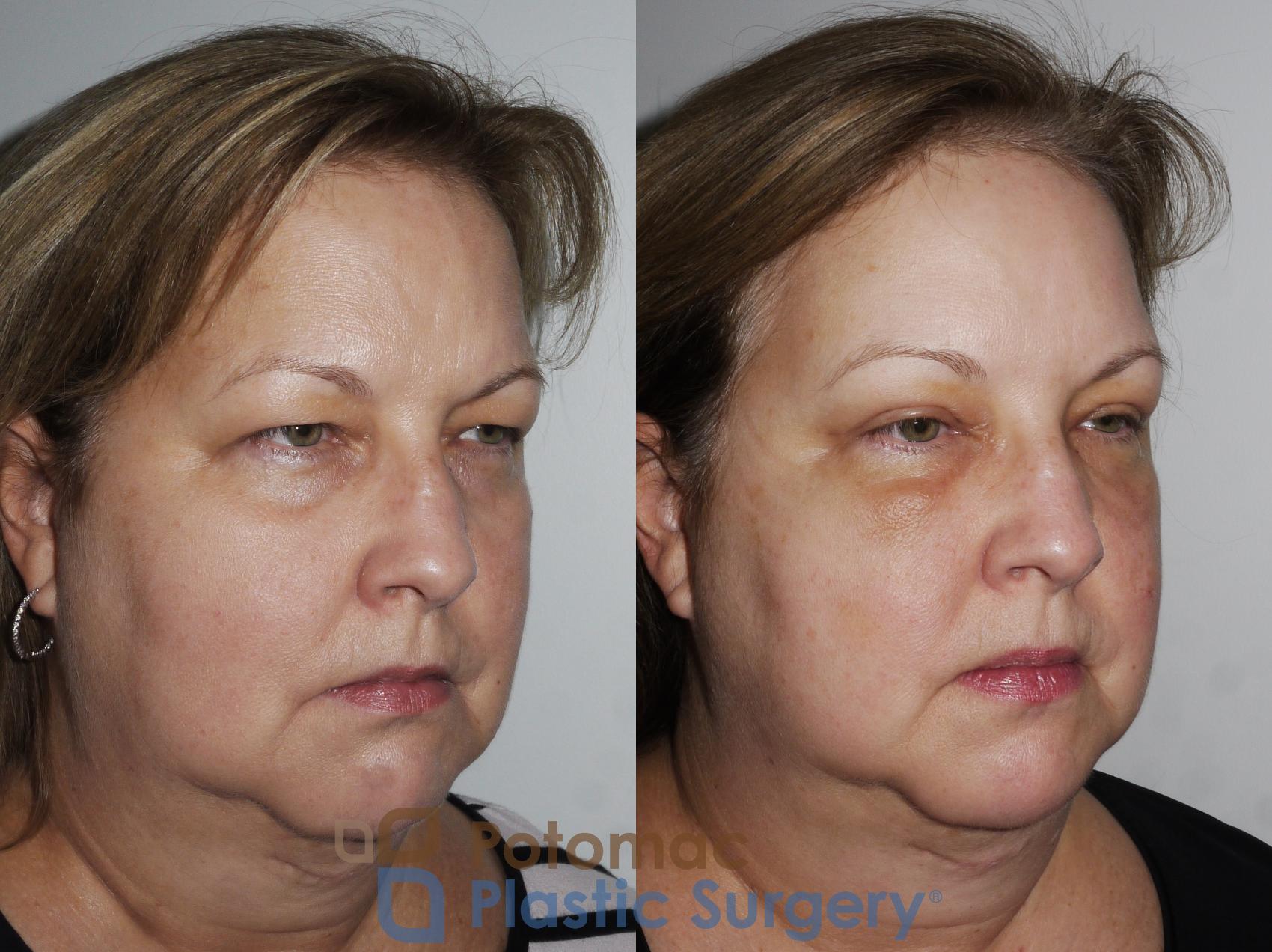 Before & After Blepharoplasty Case 232 Right Oblique View in Washington, DC