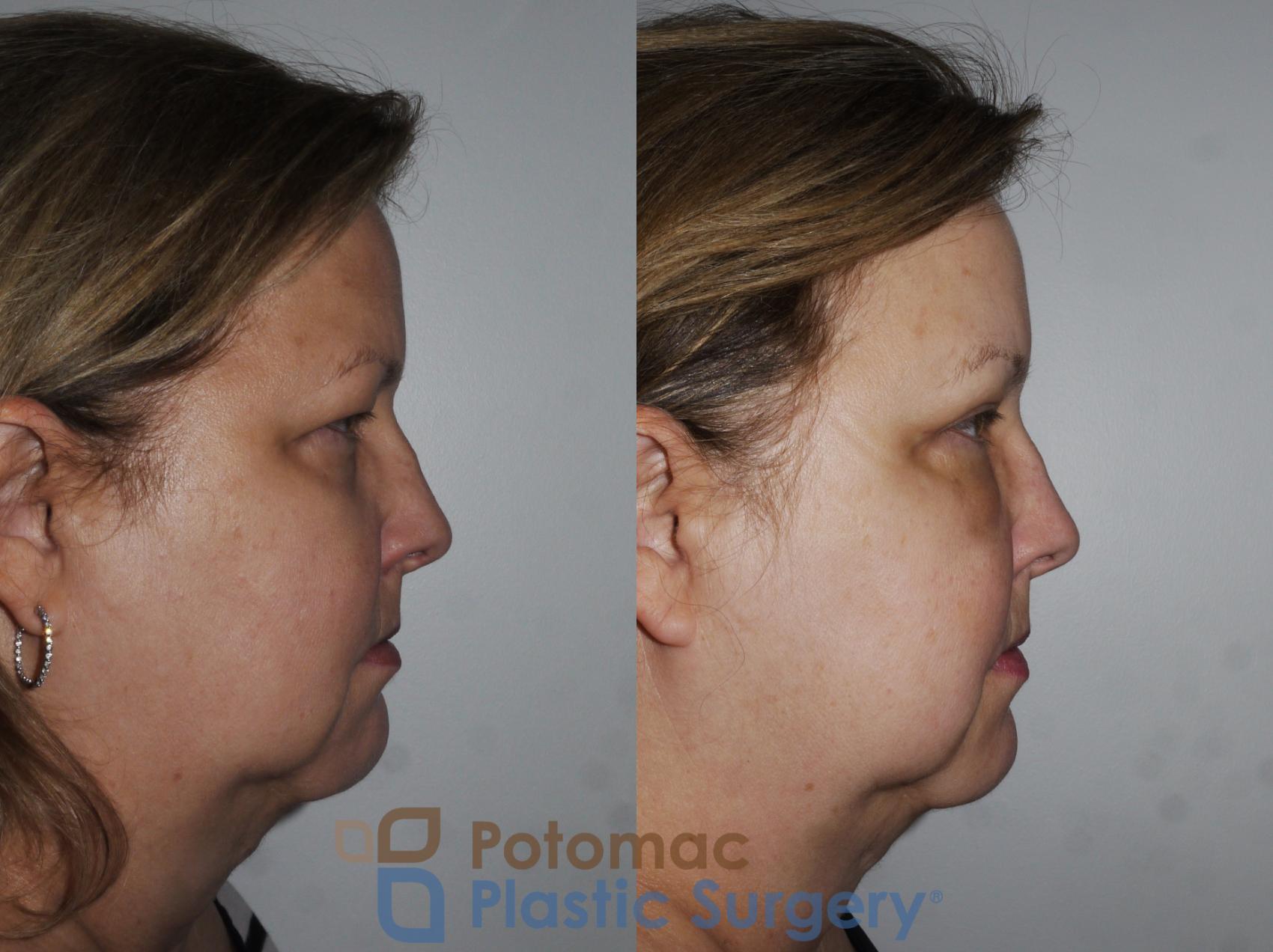 Before & After Blepharoplasty Case 232 Right Side View in Washington, DC