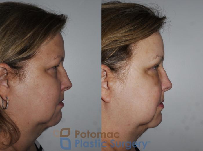 Before & After Brow Lift Case 232 Right Side View in Washington, DC