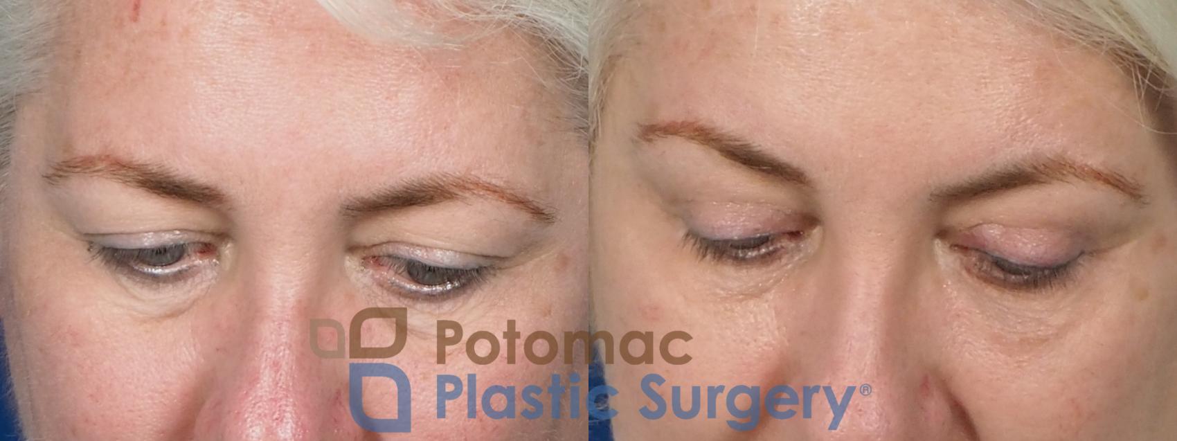 Before & After Dermal Fillers Case 237 Above View in Washington, DC