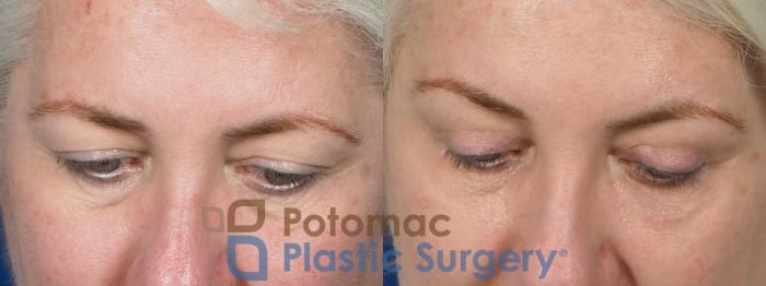 Before & After Dermal Fillers Case 237 Above View in Washington DC & Arlington , DC