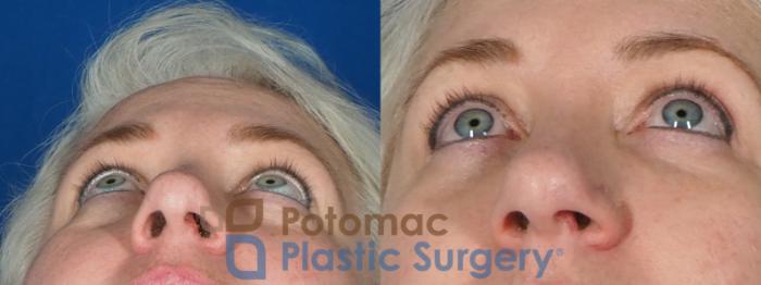 Before & After Blepharoplasty Case 237 Below View in Washington DC & Arlington , DC