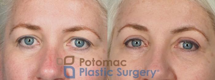 Before & After Dermal Fillers Case 237 Front View in Washington DC & Arlington , DC
