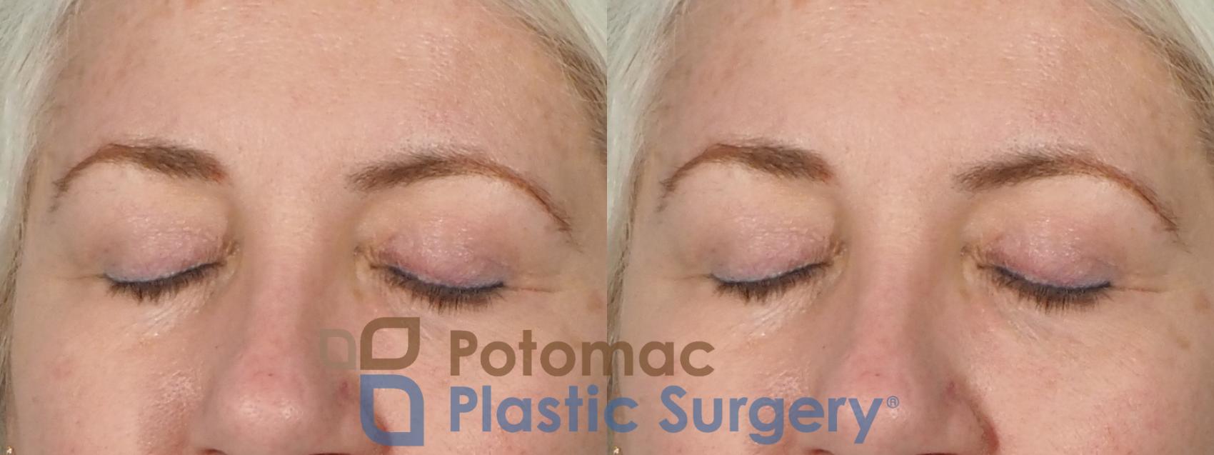 Before & After Dermal Fillers Case 237 Front View #2 View in Washington, DC