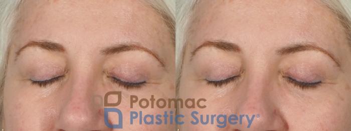 Before & After Blepharoplasty Case 237 Front View #2 View in Washington DC & Arlington , DC