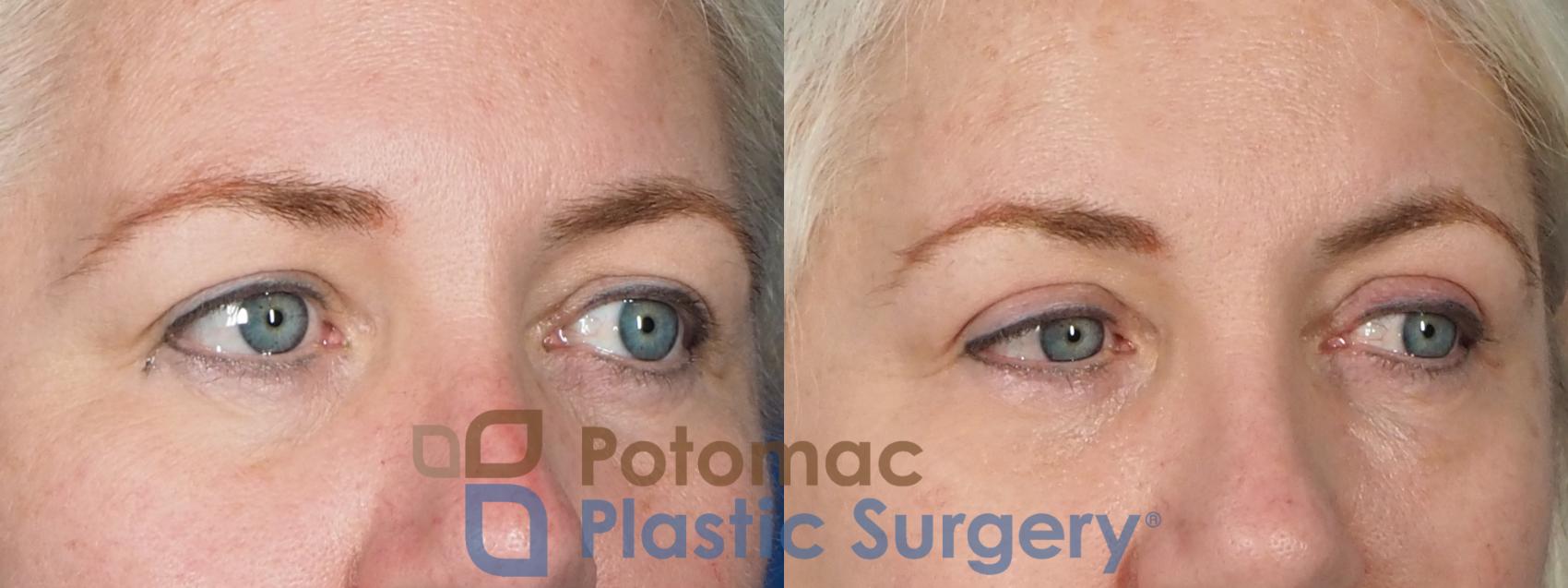 Before & After Dermal Fillers Case 237 Right Oblique View in Washington, DC