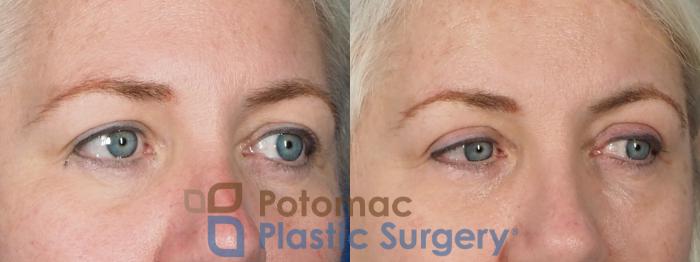 Before & After Blepharoplasty Case 237 Right Oblique View in Washington DC & Arlington , DC