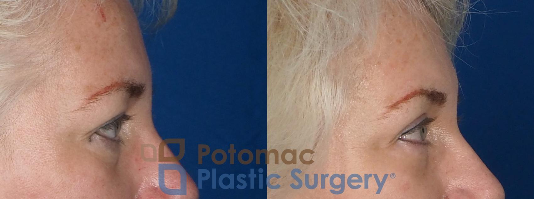 Before & After Dermal Fillers Case 237 Right Side View in Washington, DC