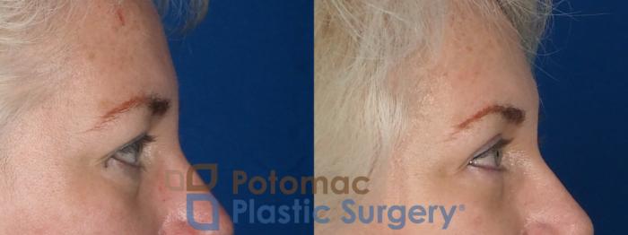 Before & After Blepharoplasty Case 237 Right Side View in Washington DC & Arlington , DC