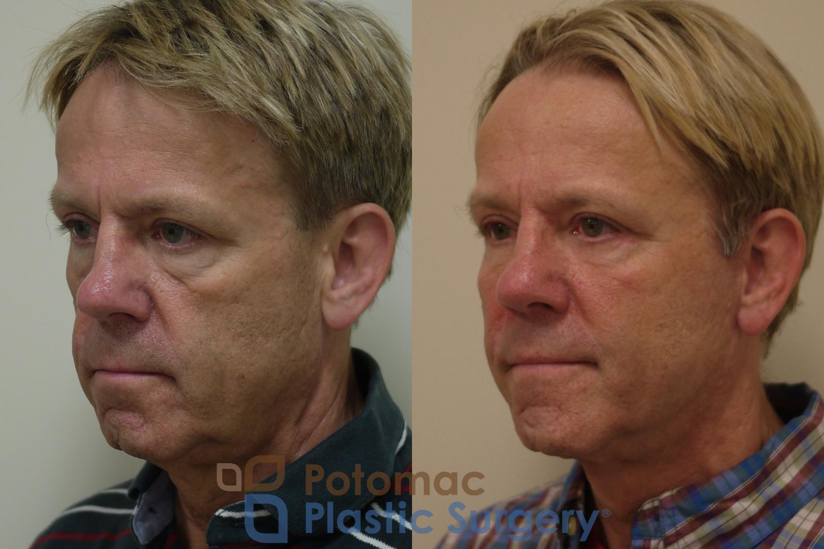 Before & After Blepharoplasty Case 260 Left Oblique View in Washington, DC