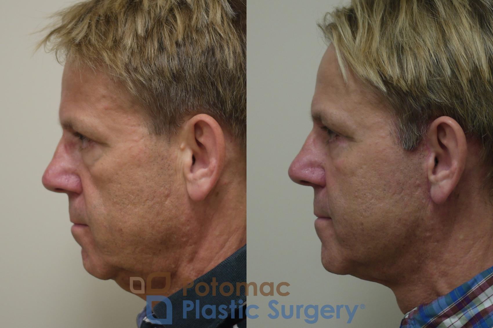 Before & After Blepharoplasty Case 260 Left Side View in Washington, DC
