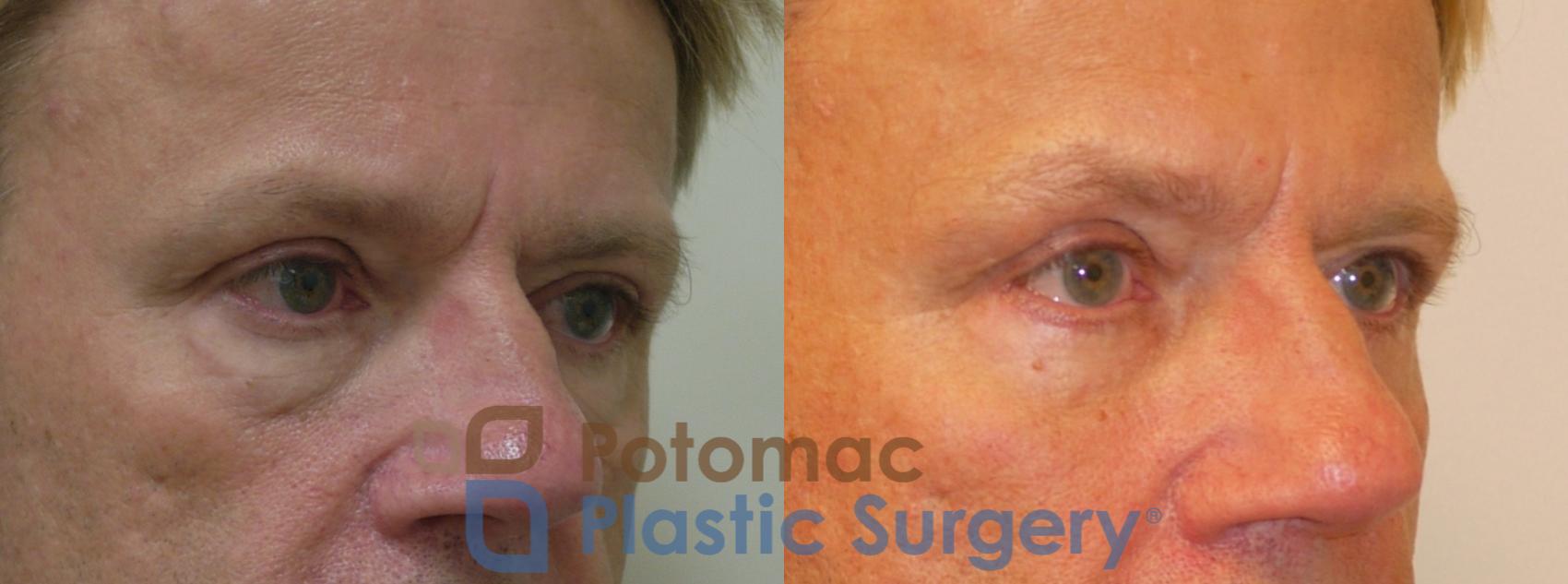 Before & After Blepharoplasty Case 260 Right Oblique Close-Up View in Washington, DC
