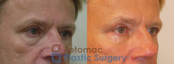 Before & After Blepharoplasty Case 260 Right Oblique Close-Up View in Washington DC & Arlington , DC