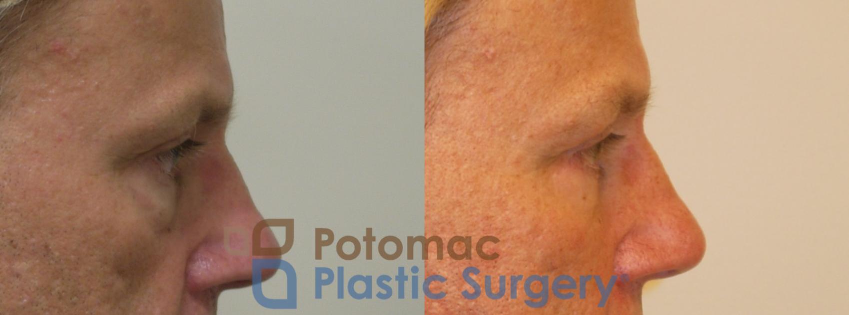 Before & After Blepharoplasty Case 260 Right Side Close-Up View in Washington, DC