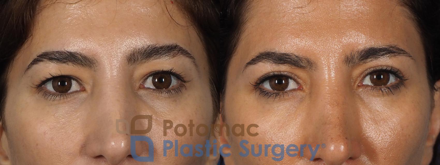 Before & After Blepharoplasty (Eyelid Surgery) Case 261 Front Close-Up View #1 View in Washington DC & Arlington , DC