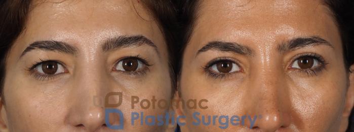 Before & After Blepharoplasty Case 261 Front Close-Up View #1 View in Washington DC & Arlington , DC