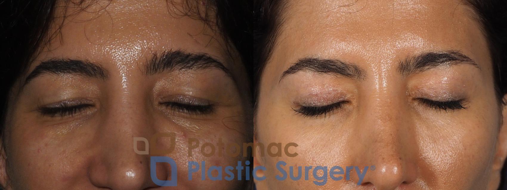 Before & After Blepharoplasty (Eyelid Surgery) Case 261 Front Close-Up View #2 View in Washington DC & Arlington , DC