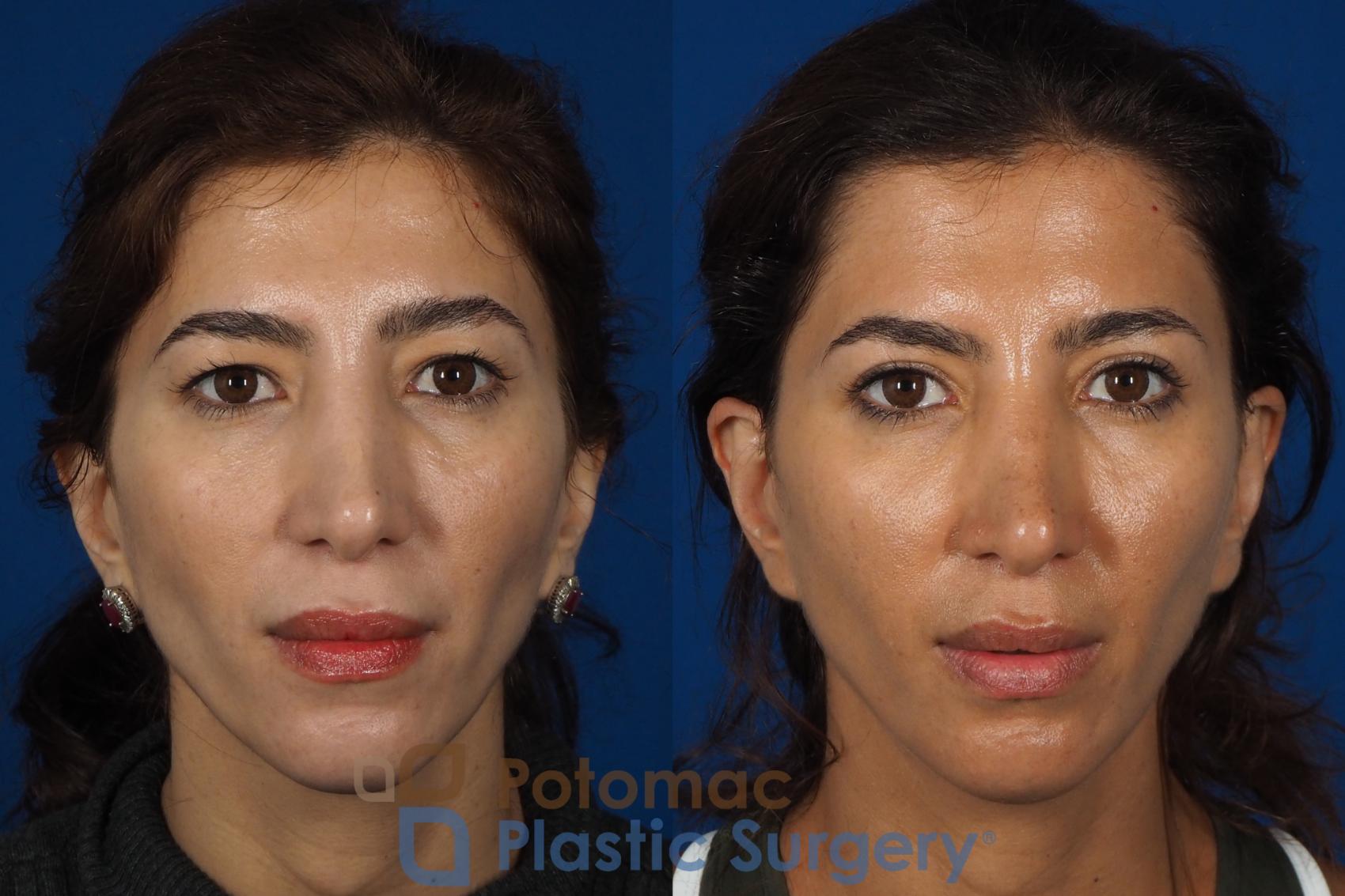 Before & After Blepharoplasty Case 261 Front View #1 View in Washington DC & Arlington , DC