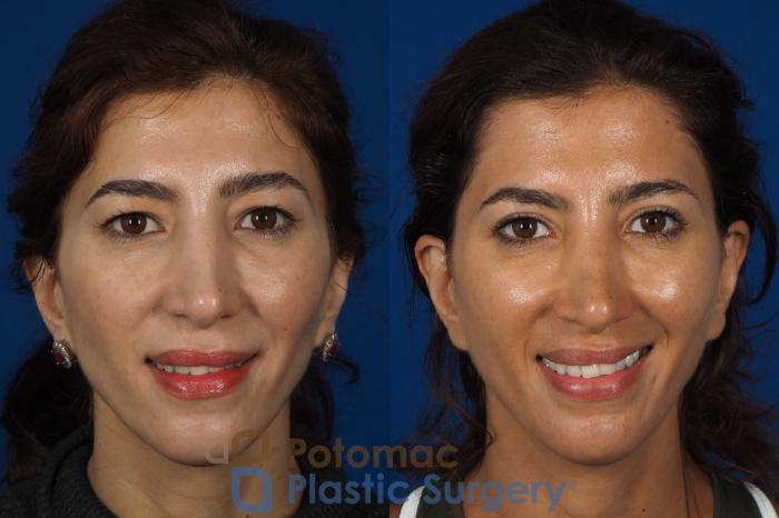 Before & After Blepharoplasty Case 261 Front View #2 View in Washington DC & Arlington , DC