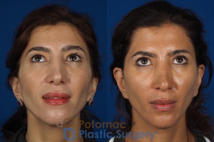Before & After Blepharoplasty Case 261 Front View #3 View in Washington DC & Arlington , DC
