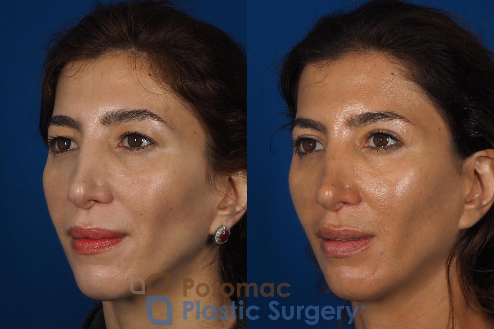 Before & After Blepharoplasty (Eyelid Surgery) Case 261 Left Oblique View in Washington DC & Arlington , DC