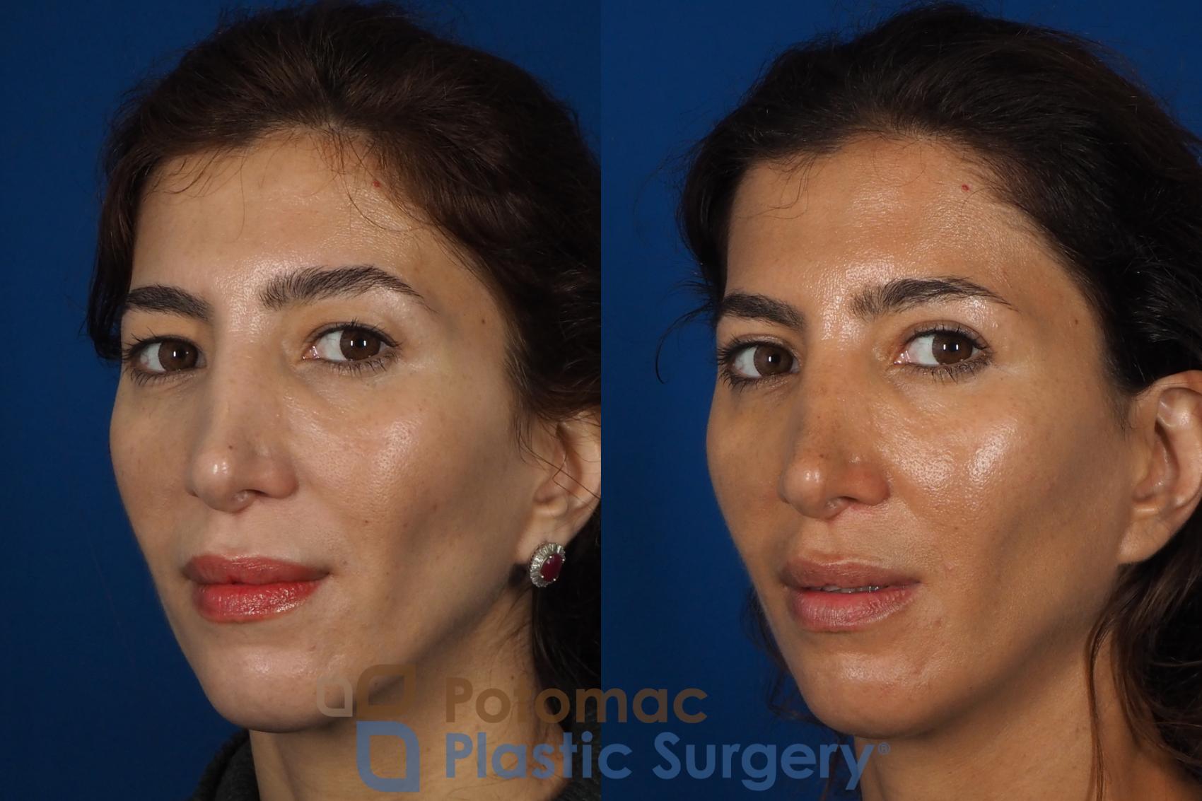 Before & After Blepharoplasty (Eyelid Surgery) Case 261 Left Oblique View #2 View in Washington DC & Arlington , DC