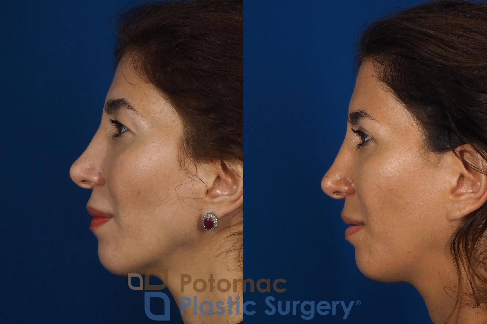 Before & After Blepharoplasty (Eyelid Surgery) Case 261 Left Side View in Washington DC & Arlington , DC