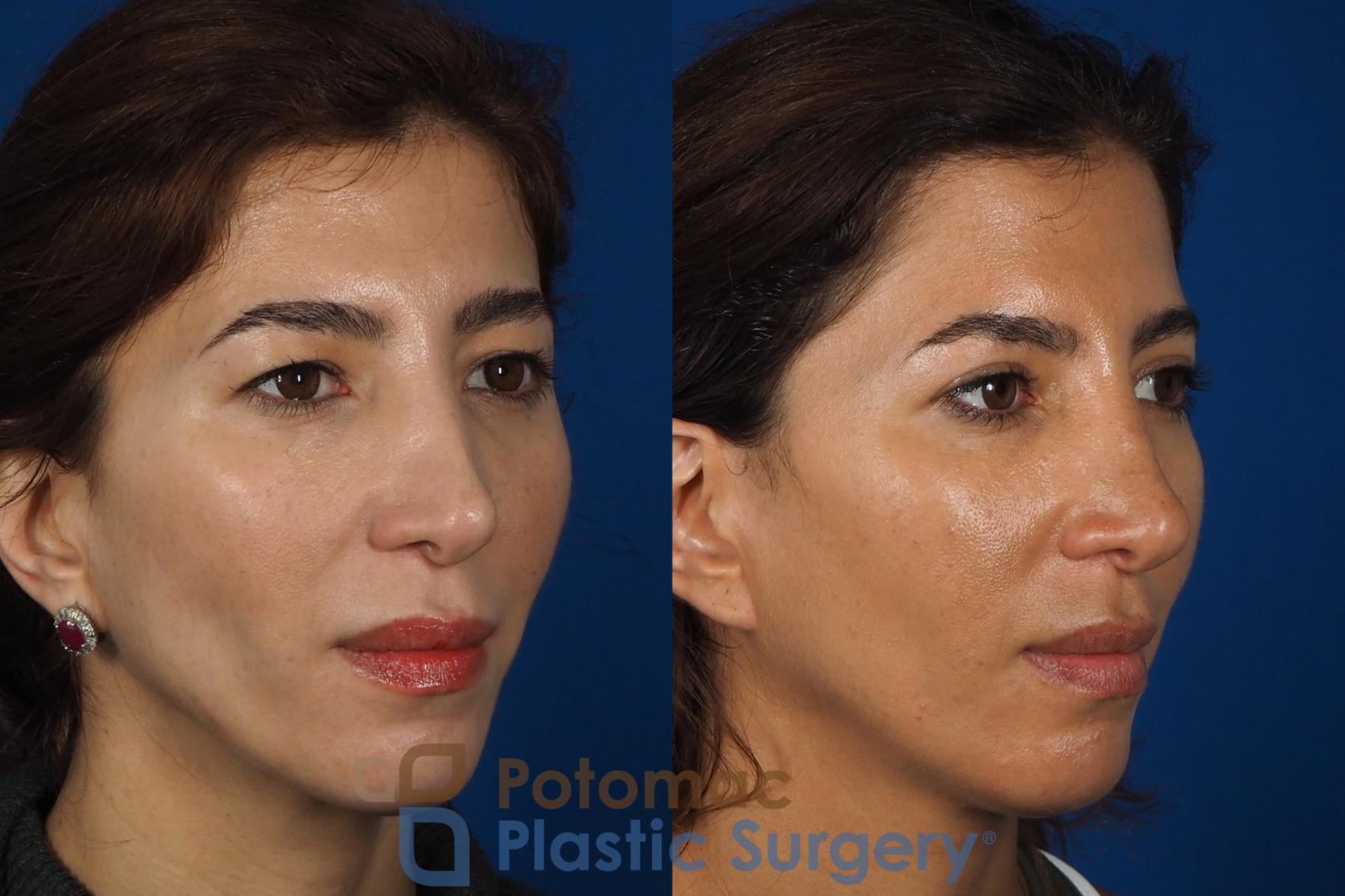 Before & After Blepharoplasty (Eyelid Surgery) Case 261 Right Oblique View in Washington DC & Arlington , DC