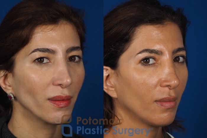 Before & After Blepharoplasty Case 261 Right Oblique View #2 View in Washington DC & Arlington , DC