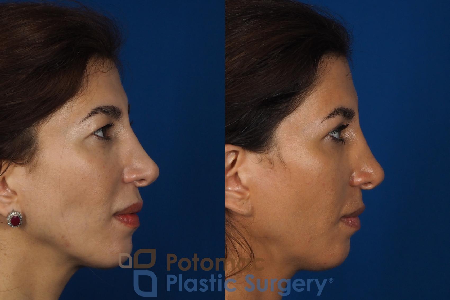 Before & After Blepharoplasty (Eyelid Surgery) Case 261 Right Side View in Washington DC & Arlington , DC