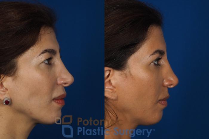 Before & After Blepharoplasty Case 261 Right Side View in Washington DC & Arlington , DC