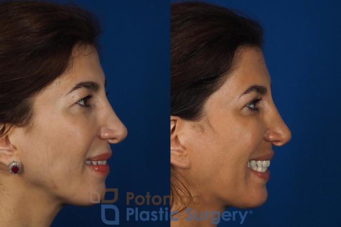 Before & After Blepharoplasty Case 261 Right Side View #2 View in Washington DC & Arlington , DC